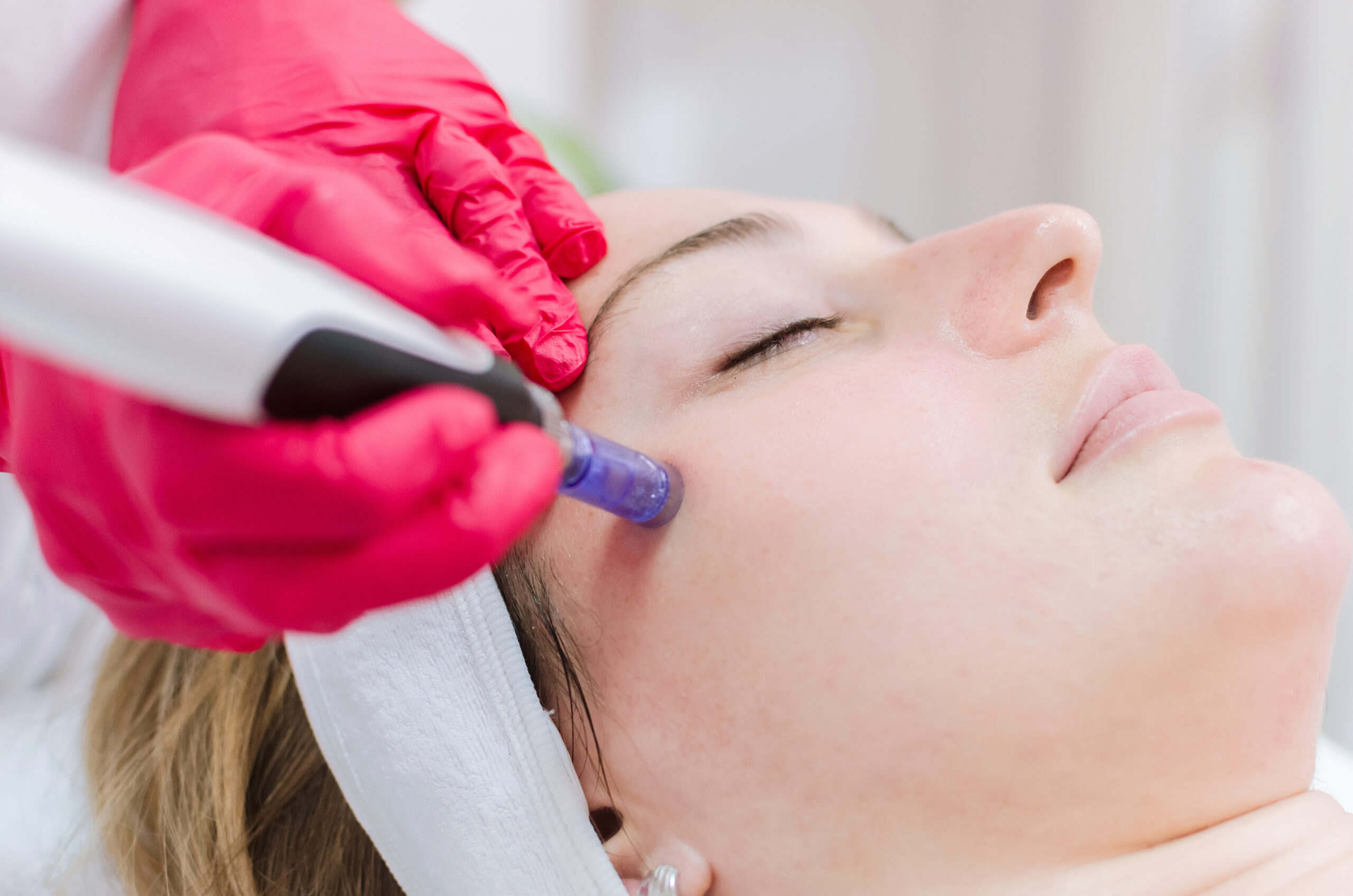 How Much Is Microneedling?