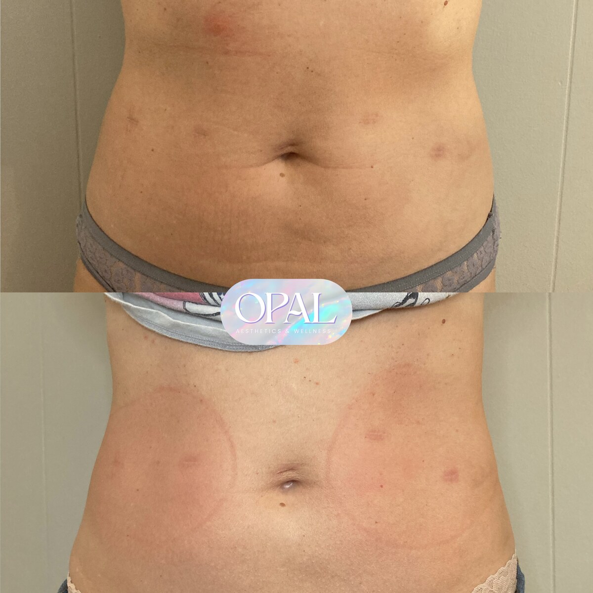 Before and after body contouring results at Opal Aesthetics & Wellness in Dripping Springs, Texas