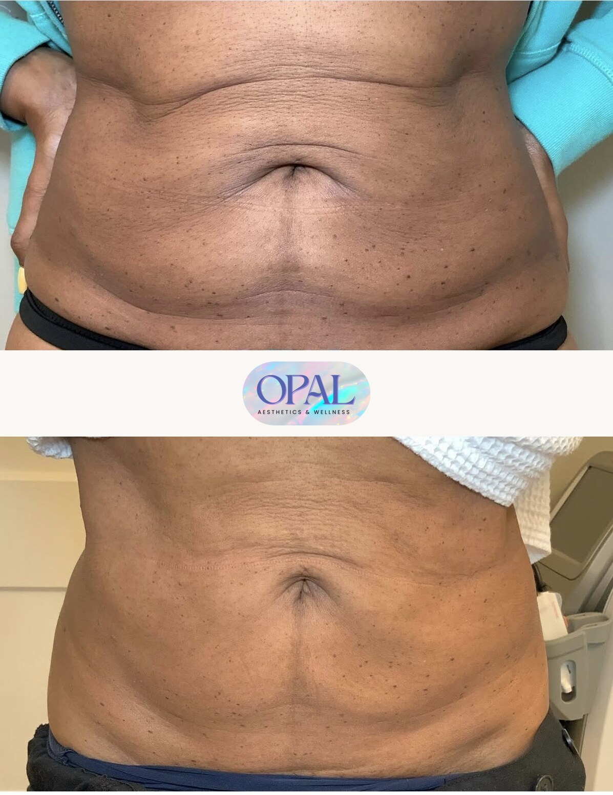 Before and after body contouring results, front view, at Opal Aesthetics & Wellness