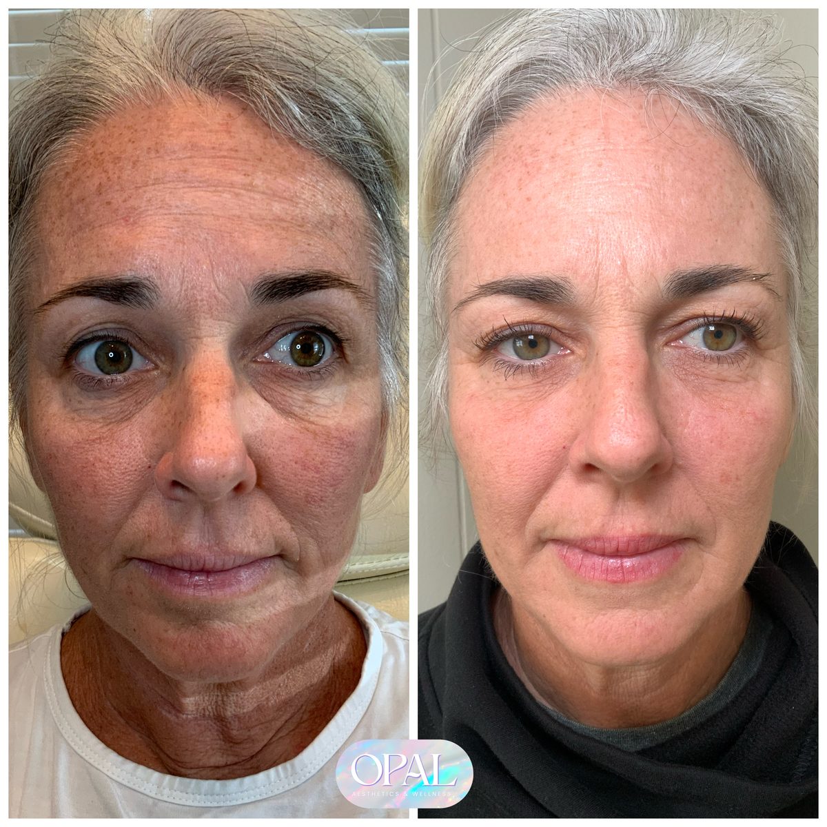 Natural rejuvenation before and after at Opal Aesthetics & Wellness