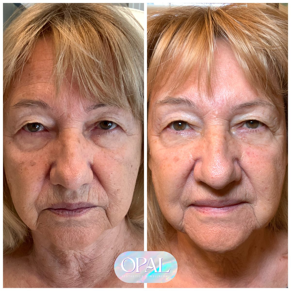 Mature skin rejuvenation before and after at Opal Aesthetics & Wellness