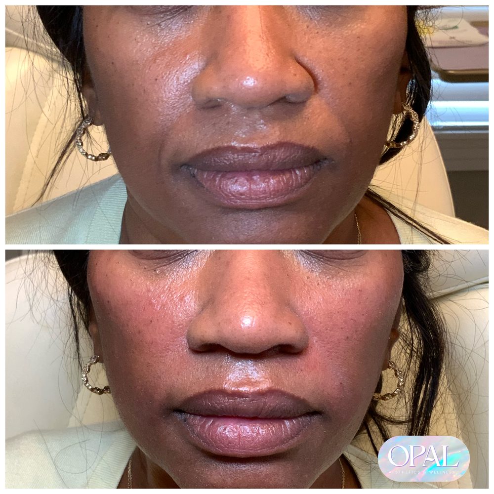 Before and after lip filler results, front view, at Opal Aesthetics & Wellness