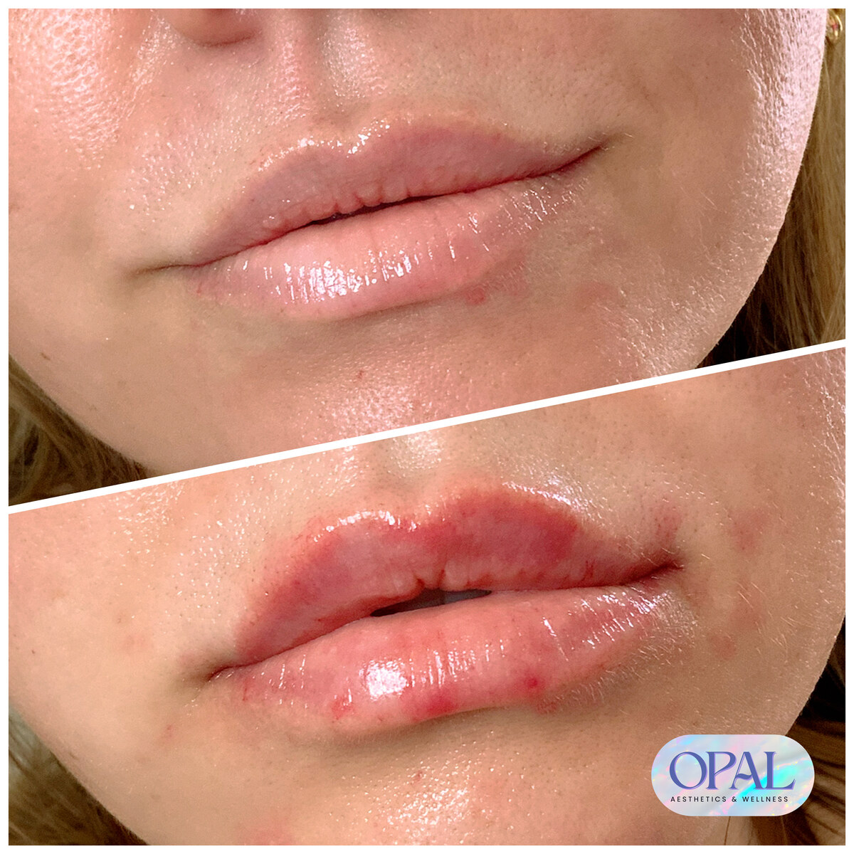 Before and after lip filler results, close-up, at Opal Aesthetics & Wellness