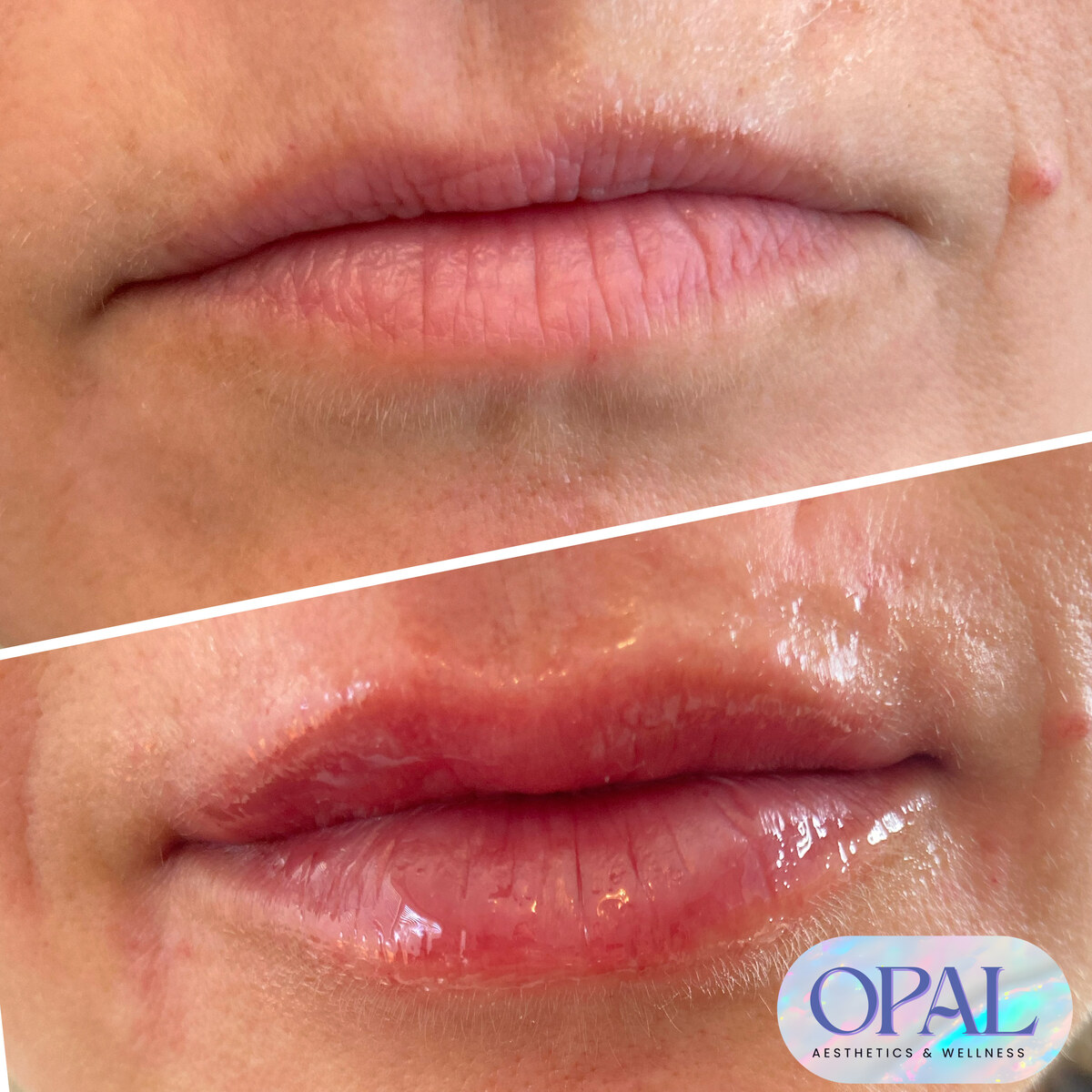 Before and after lip filler results, upper lip detail, at Opal Aesthetics & Wellness