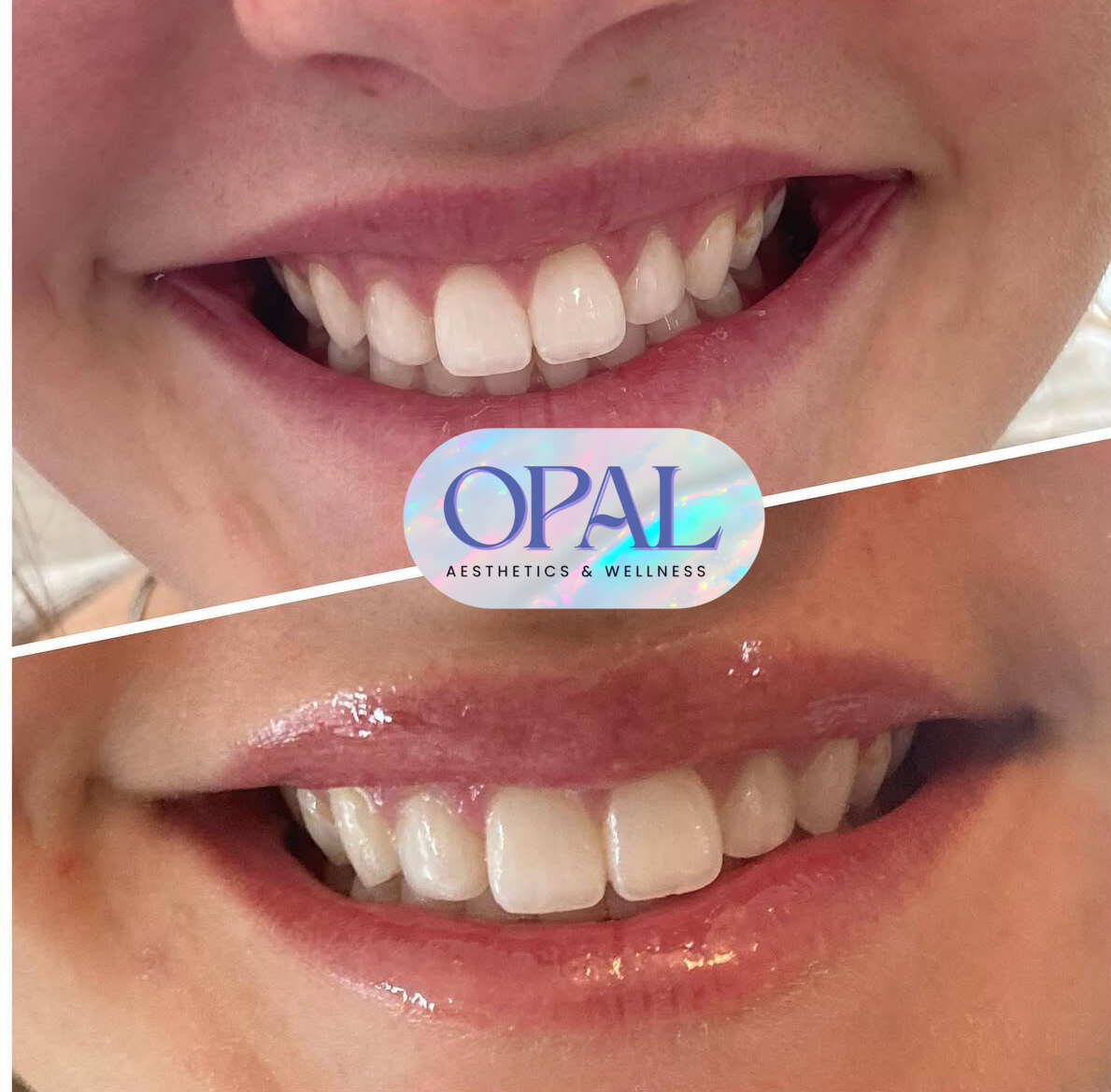 Before and after lip filler results, smiling, at Opal Aesthetics & Wellness