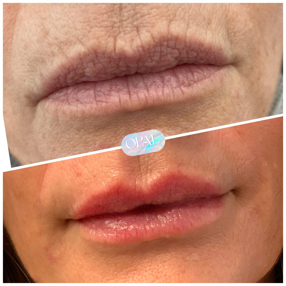 Before and after lip filler results at Opal Aesthetics & Wellness in Dripping Springs, Texas