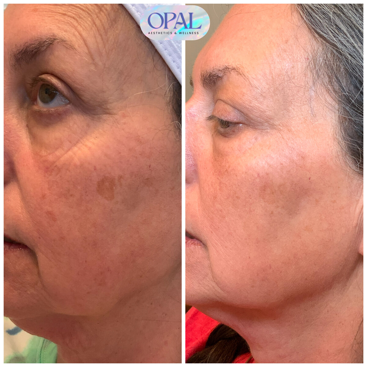 Before and after melasma and pigmentation results, side profile, at Opal Aesthetics & Wellness in Dripping Springs, Texas