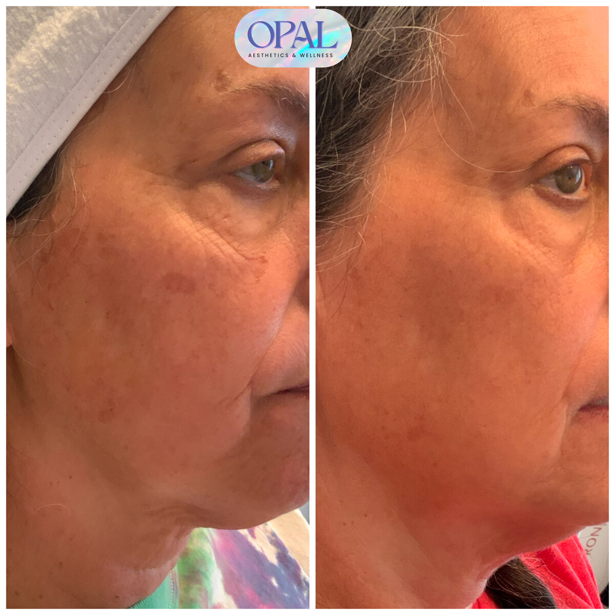 Before and after melasma and pigmentation results, close-up, at Opal Aesthetics & Wellness in Dripping Springs, Texas