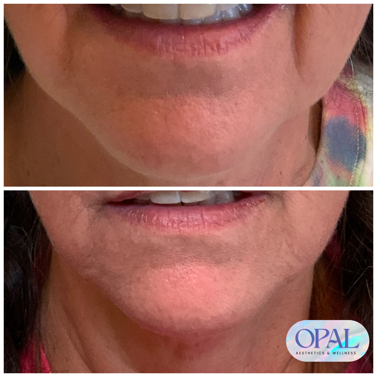 Before and after melasma and pigmentation results, chin area, at Opal Aesthetics & Wellness in Dripping Springs, Texas
