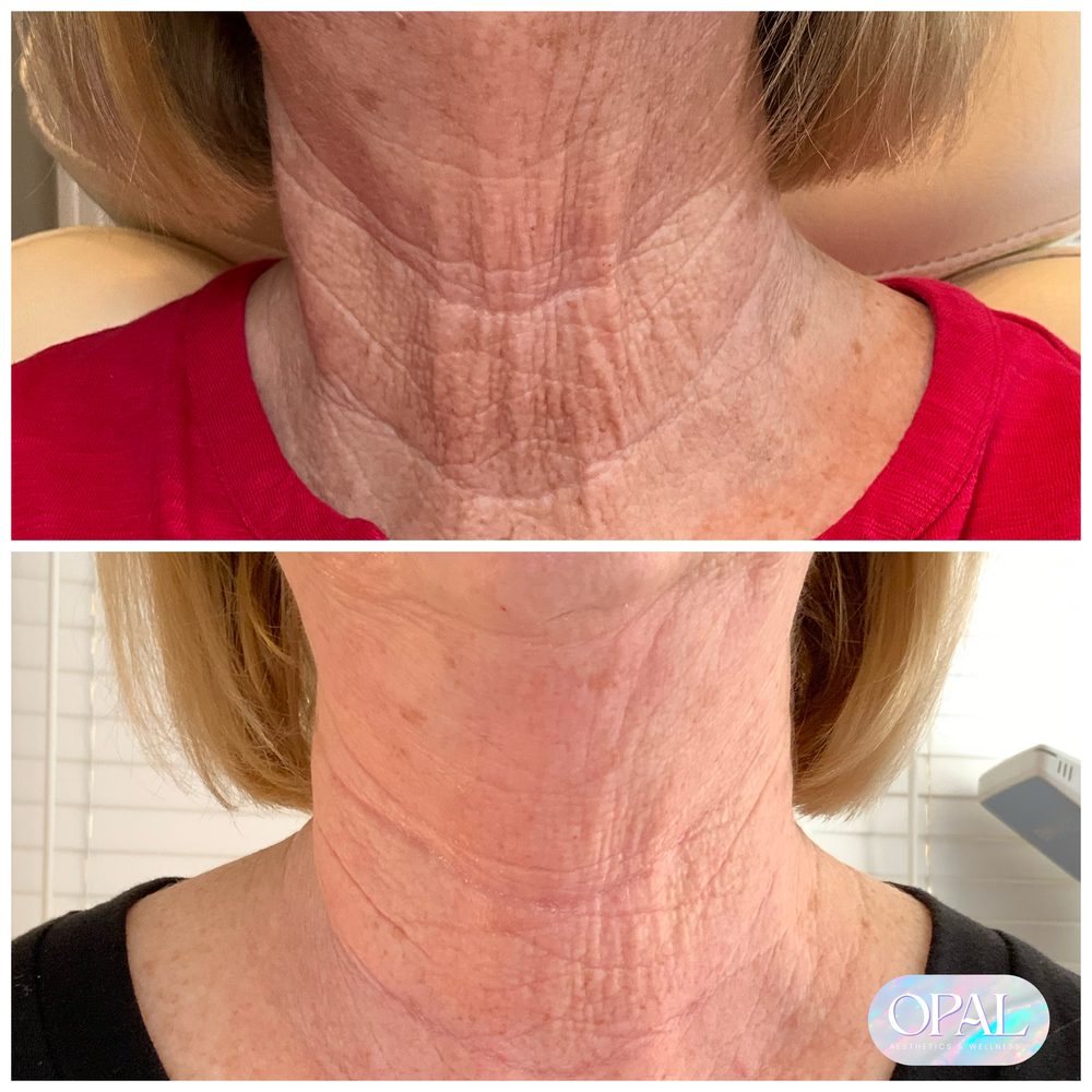 Before and after neck skin rejuvenation results at Opal Aesthetics & Wellness in Dripping Springs, Texas