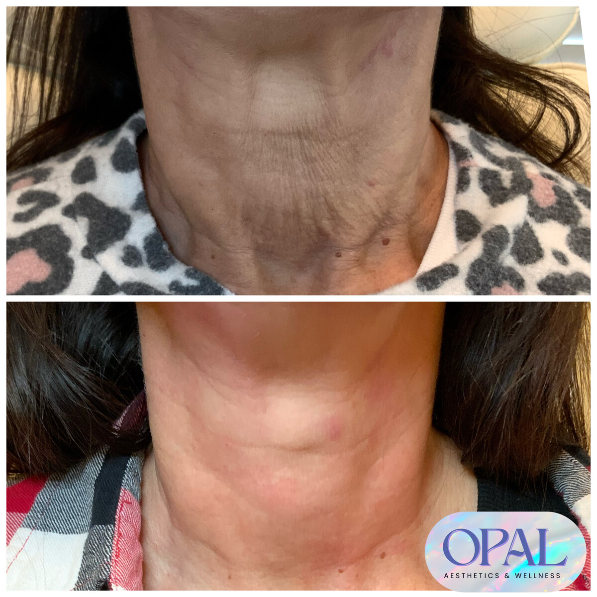 Before and after neck skin tightening results at Opal Aesthetics & Wellness in Dripping Springs, Texas