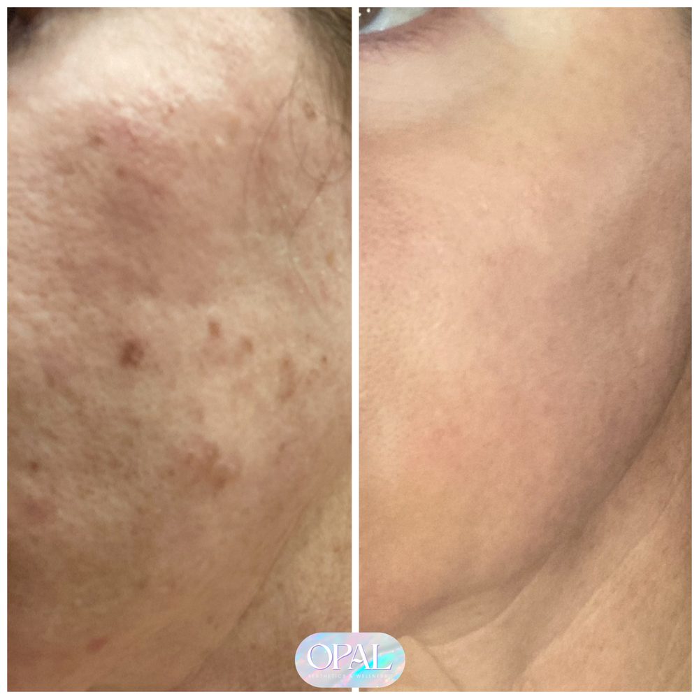 Skin tone and texture before and after at Opal Aesthetics & Wellness