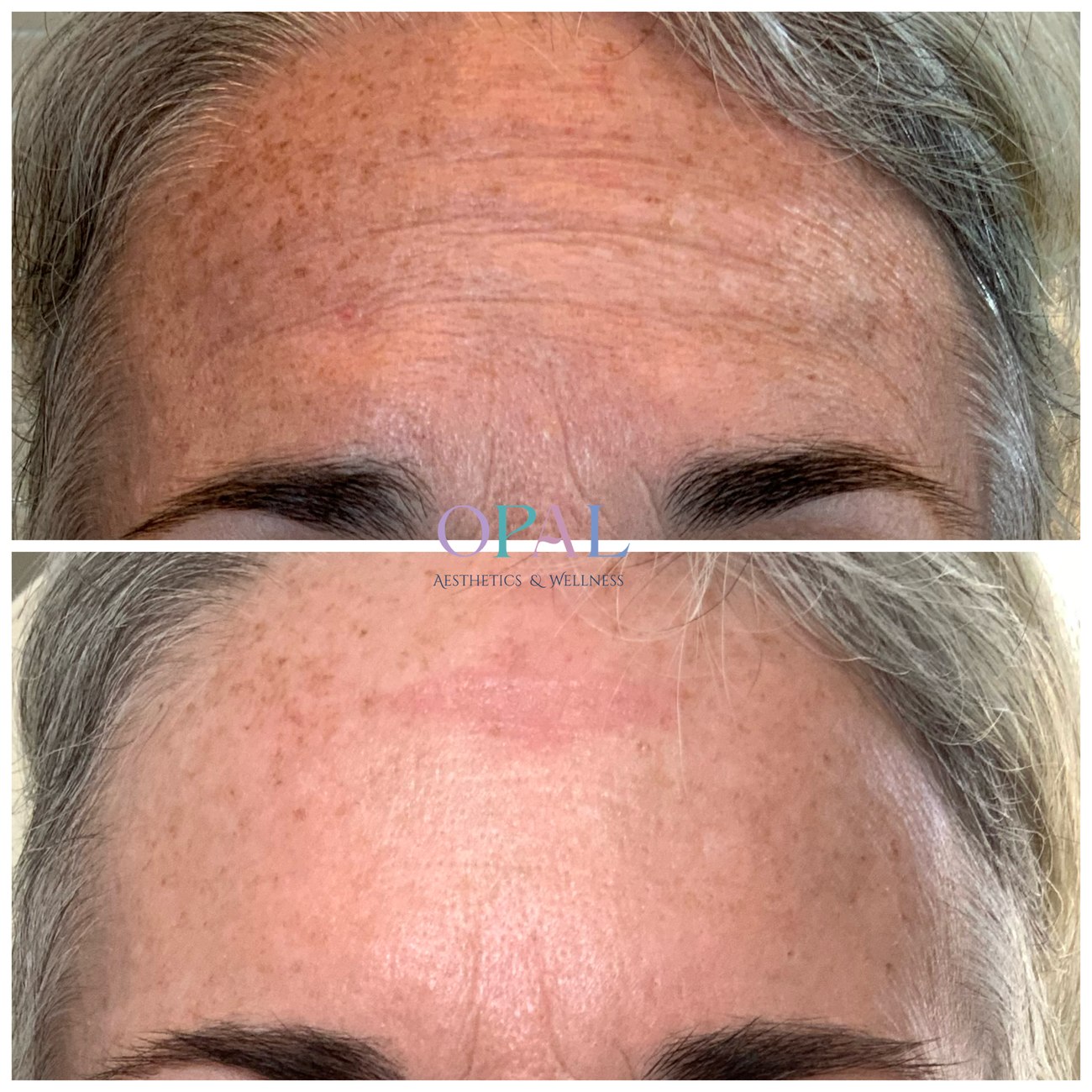 Before and after skin texture and tone rejuvenation results at Opal Aesthetics & Wellness