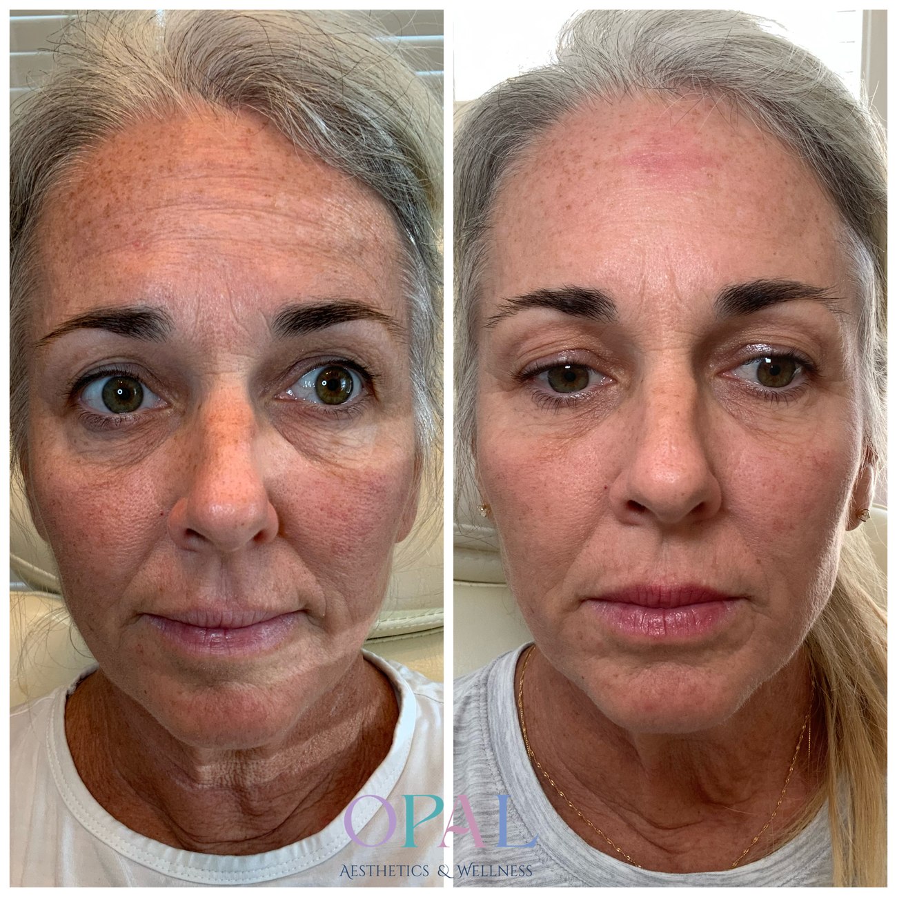 Before and after full-face skin rejuvenation results at Opal Aesthetics & Wellness