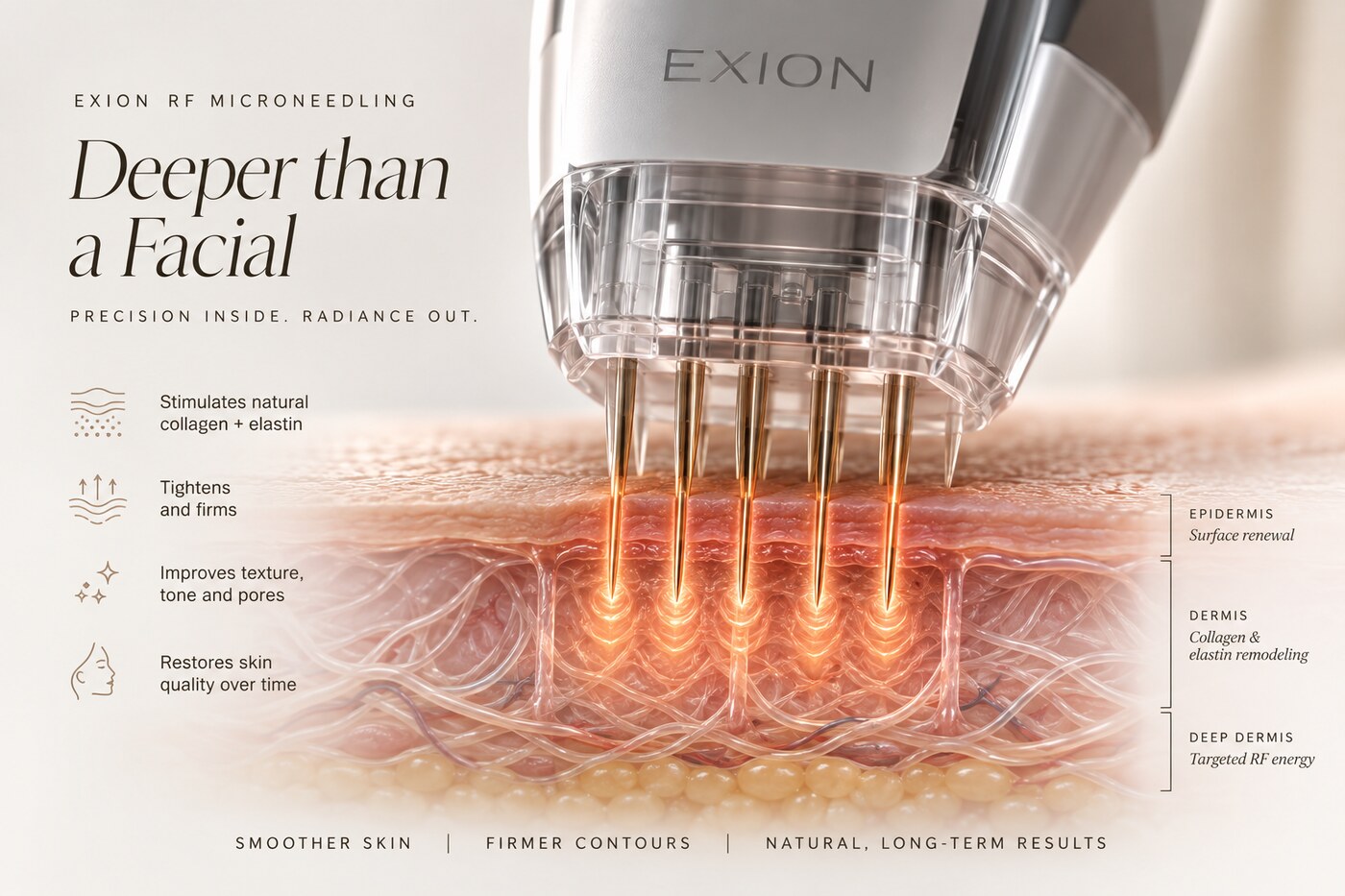 EXION RF Microneedling treatment diagram showing epidermis, dermis and deep dermis layers at Opal Aesthetics & Wellness