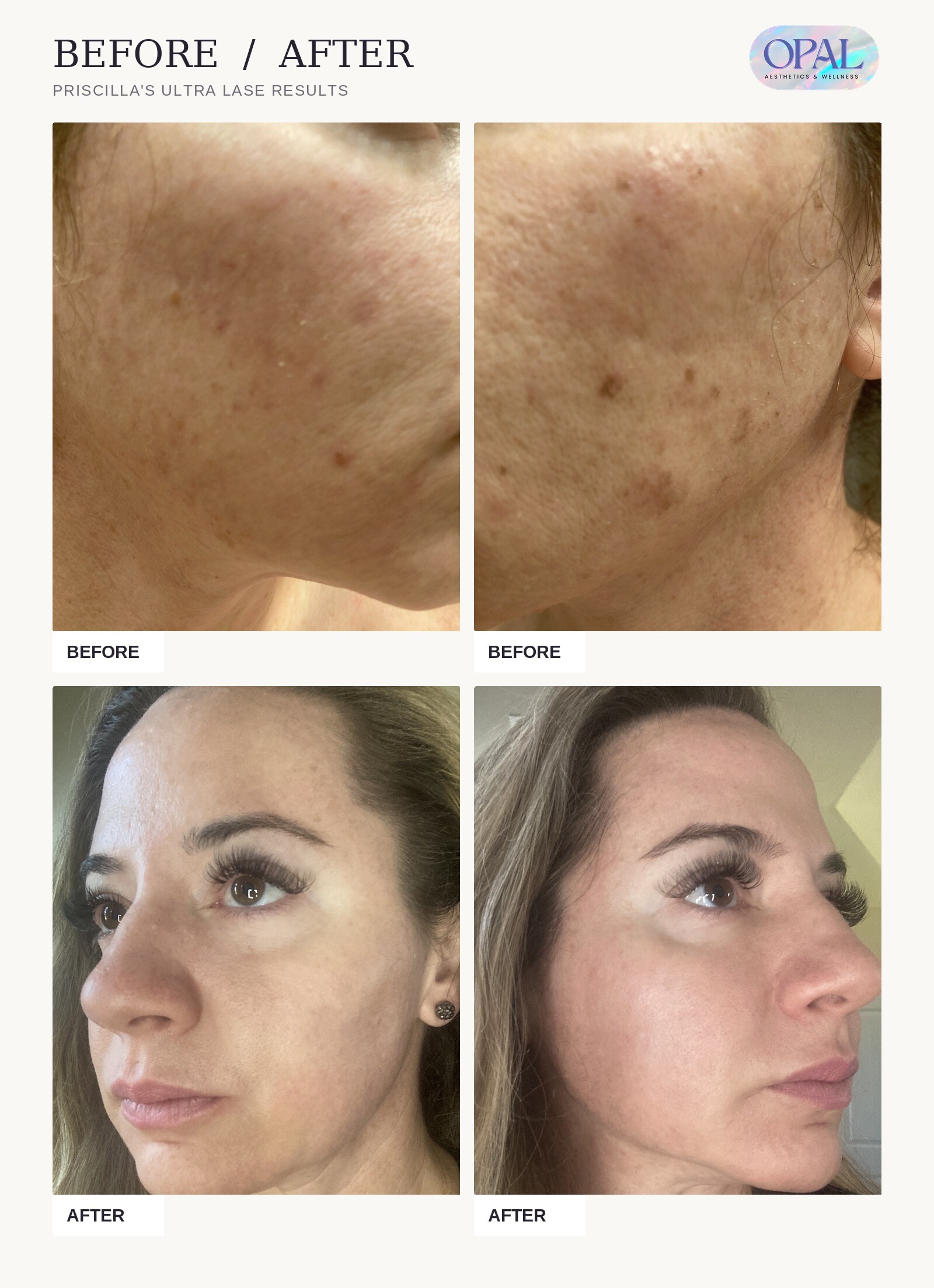 Priscilla's Ultra LaseMD before and after results at Opal Aesthetics & Wellness