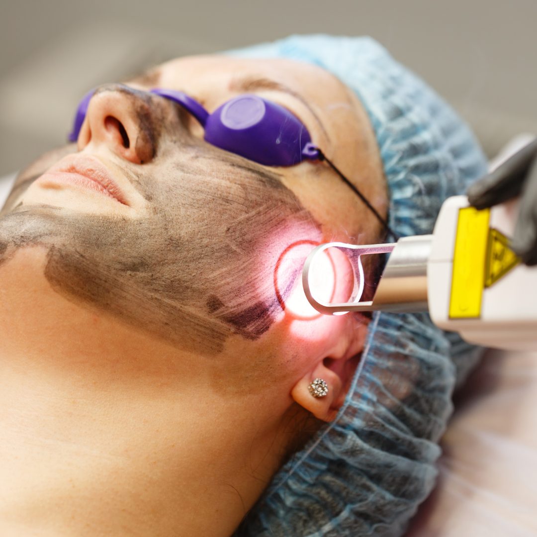 Spectra Carbon Peel treatment at Opal Aesthetics & Wellness