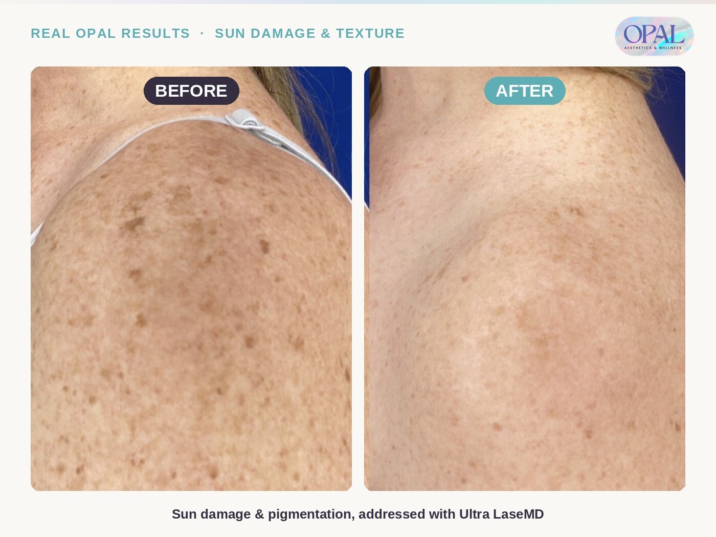 Before and after Ultra LaseMD laser resurfacing results for sun damage and pigmentation at Opal Aesthetics & Wellness