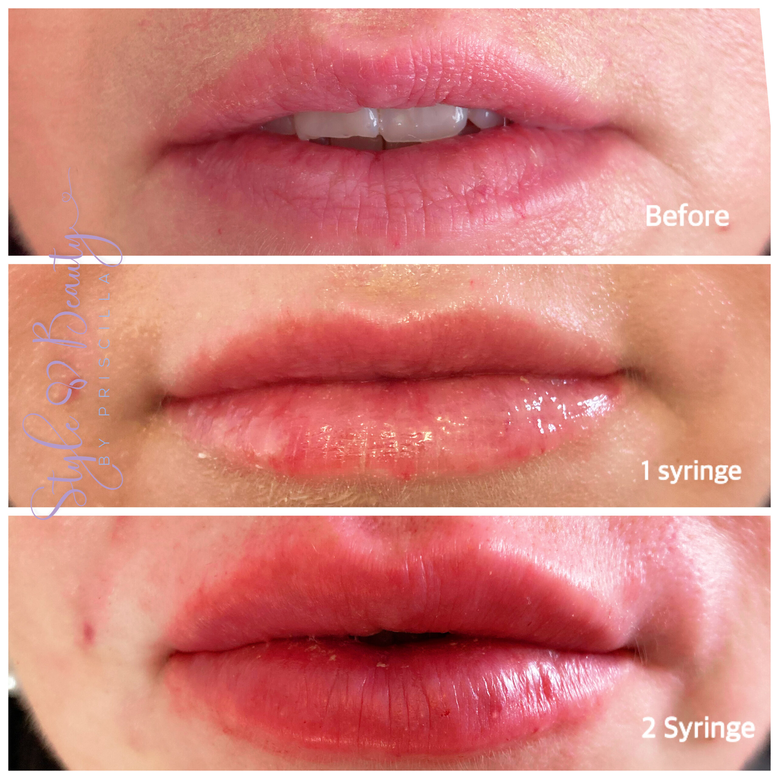 Lip Filler Before & After Image | Opal Aesthetics & Wellness | Dripping Springs, TX