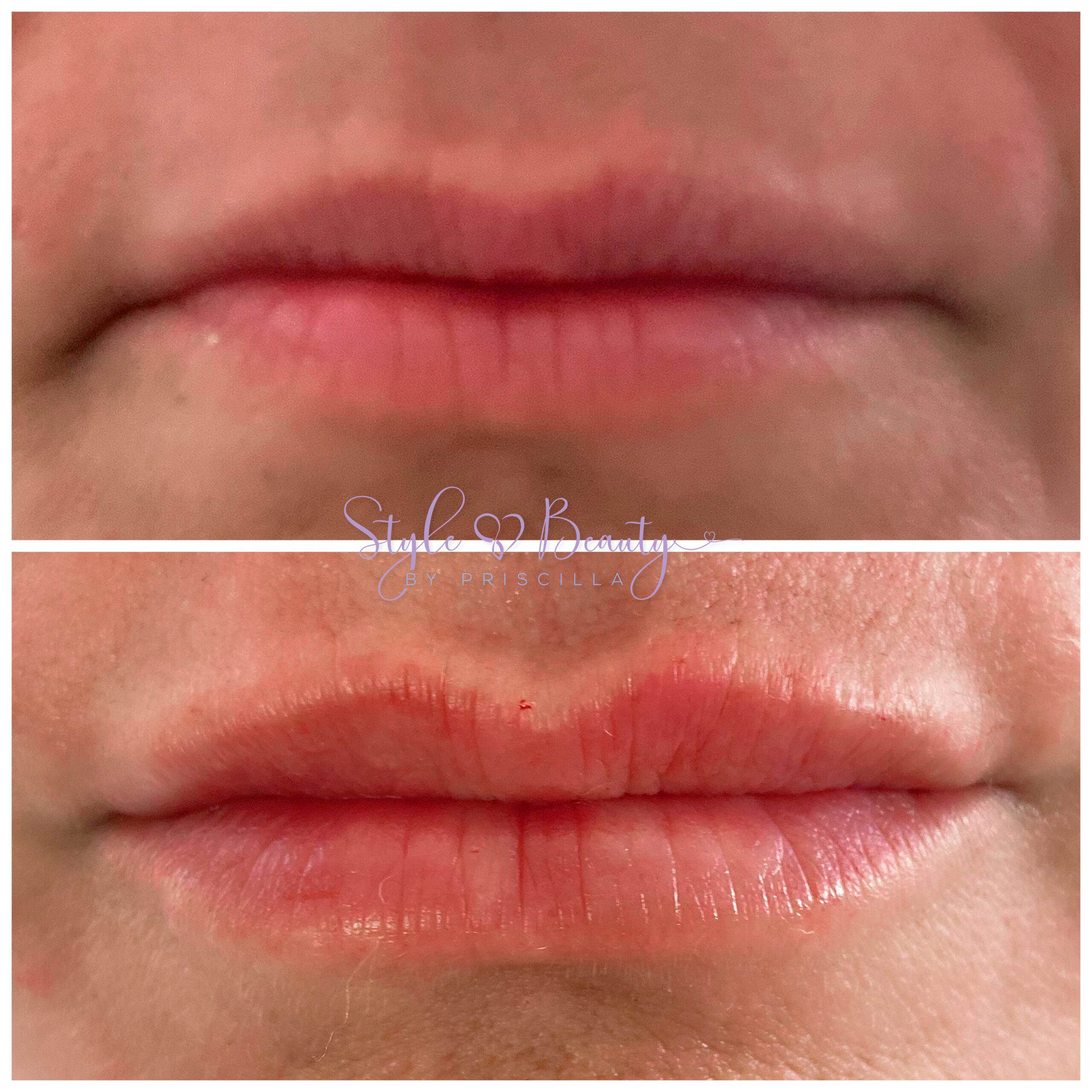 Lip Filler Before & After Image | Opal Aesthetics & Wellness | Dripping Springs, TX