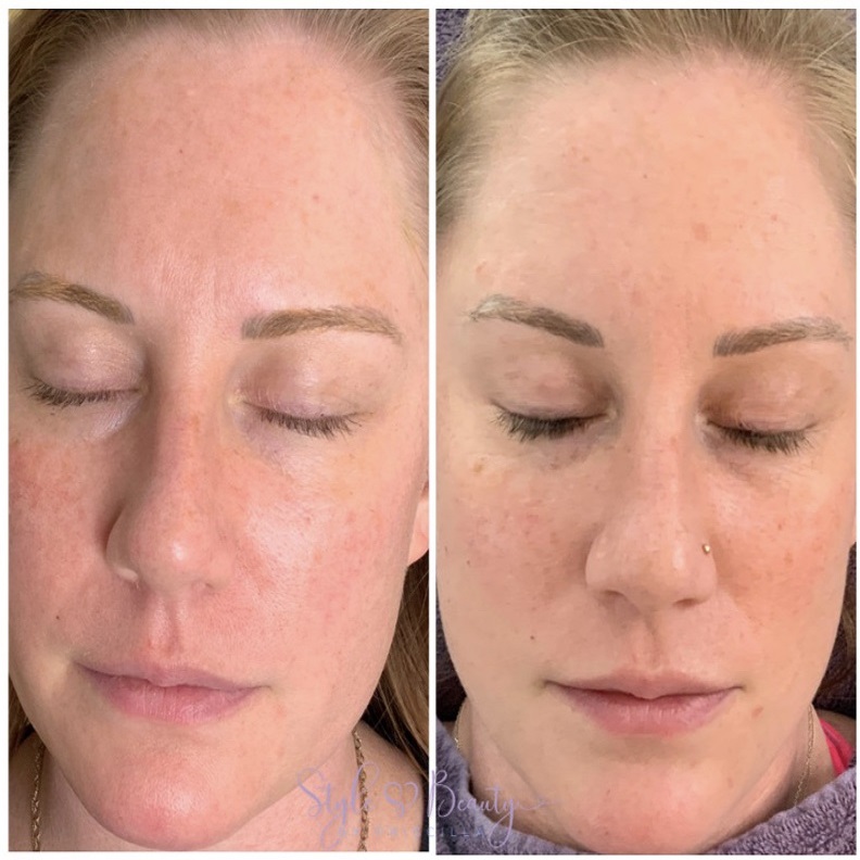 Before & After Image | Opal Aesthetics & Wellness