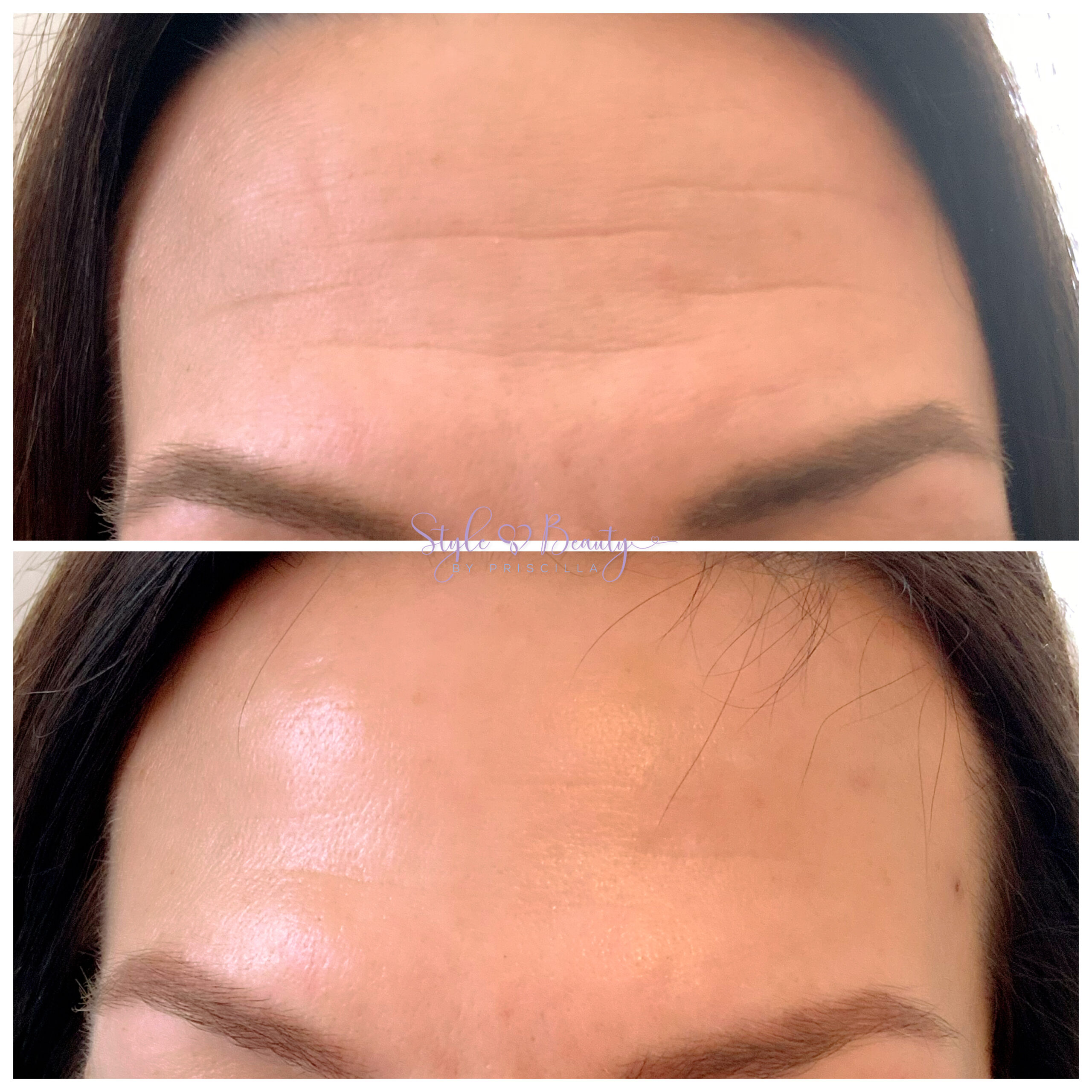Cosmetic Injection Before & After Image | Opal Aesthetics & Wellness